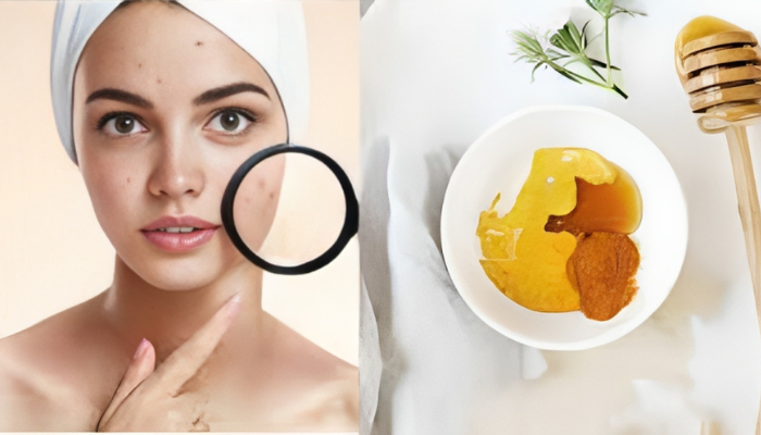 Effective Home Remedies for Acne Treatment:
